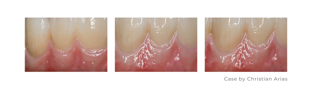 BAOT Aurora Dental Stain Glaze Case for Zirconia